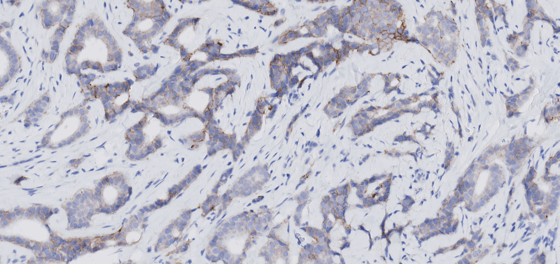 Artificial Intelligence and Digital Assay Development for Breast Cancer Pathology